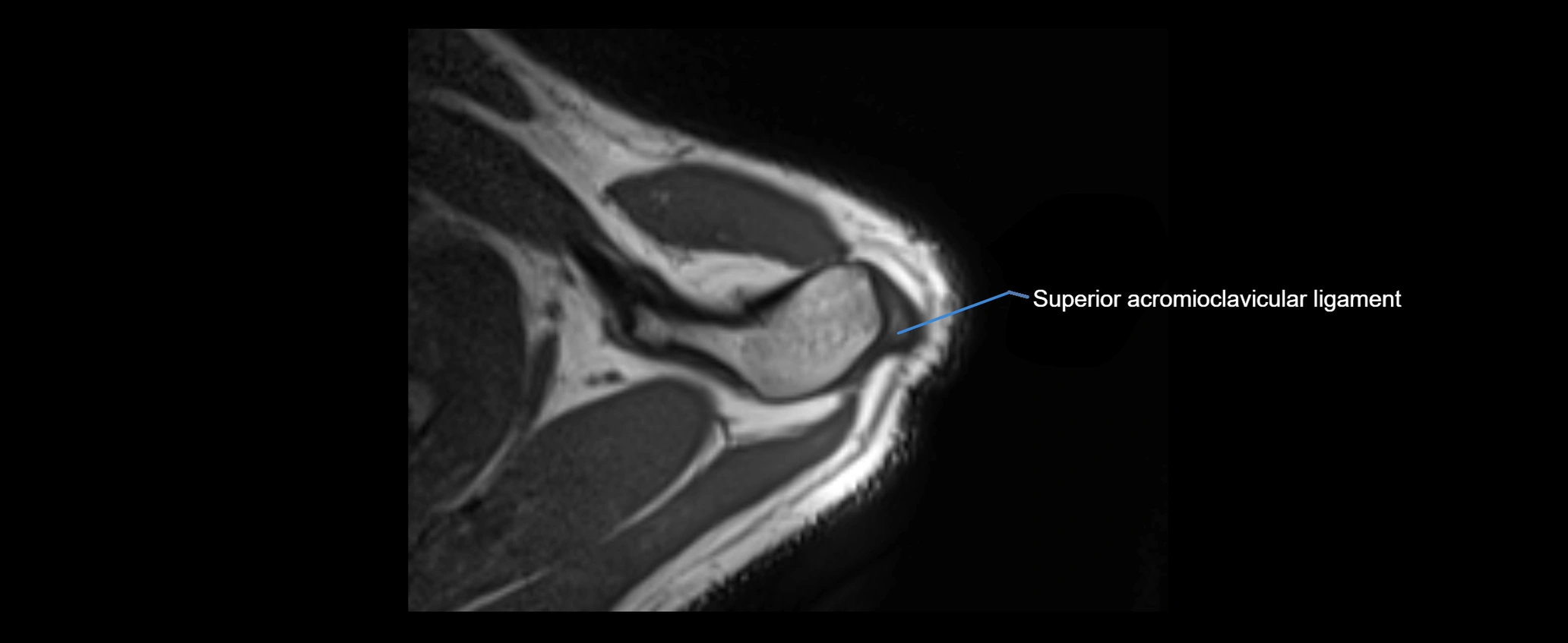 shoulder ligaments axial 3d 3t mri image-img-00005-00020.webp